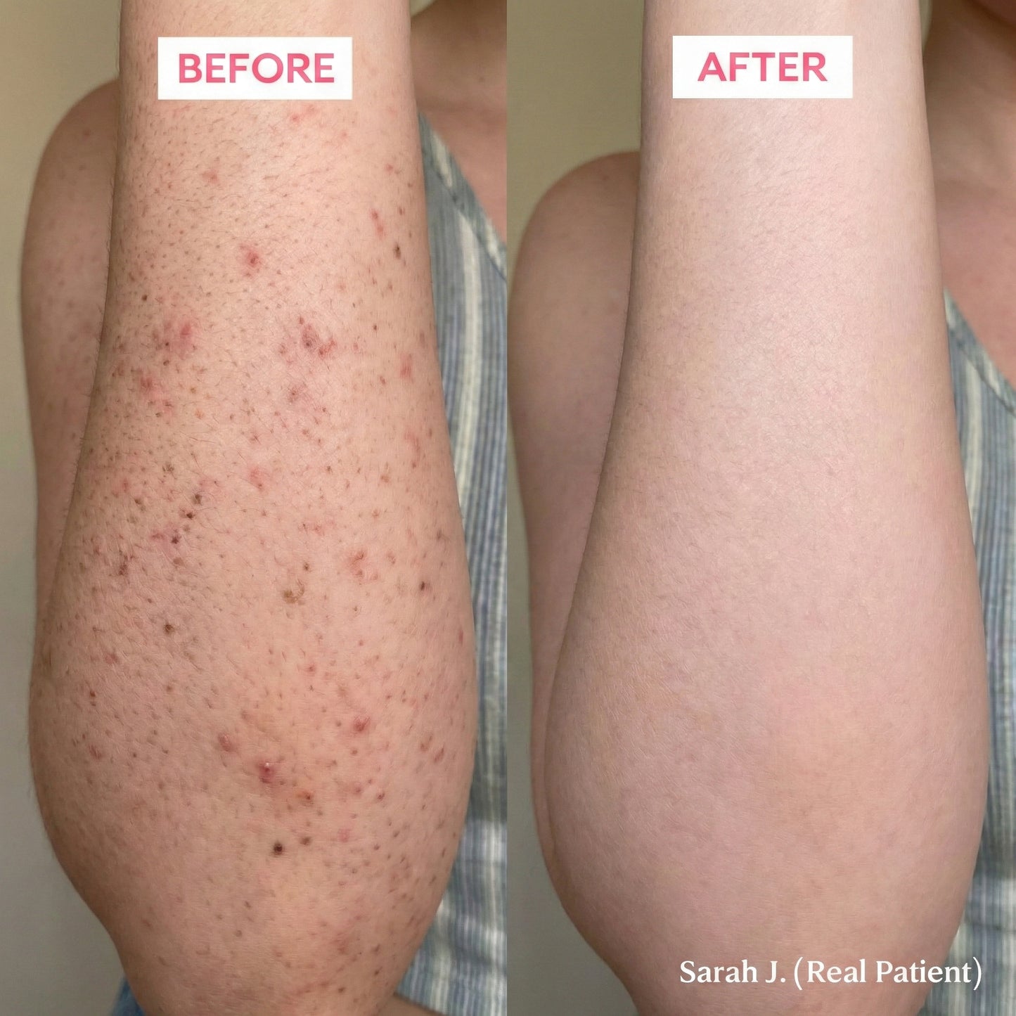 NuraLuxe® Strawberry Skin Resurfacing Cream